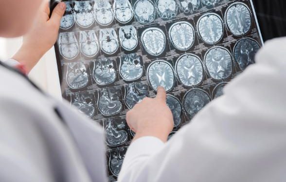 Oren Zarif – Ischemic Stroke