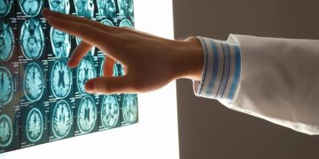 Oren Zarif – Ischemic Stroke