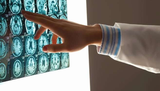 Oren Zarif – Ischemic Stroke